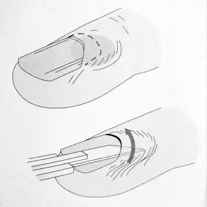 Paronychia drainage